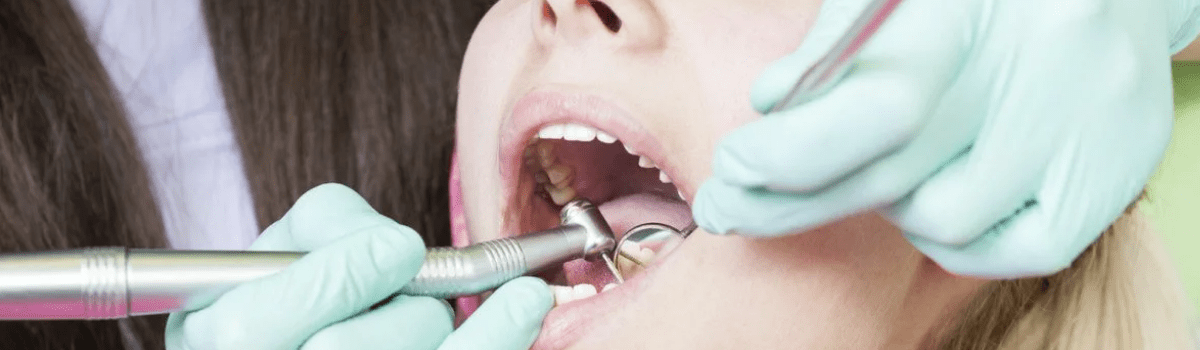 Как удалить зубной камень