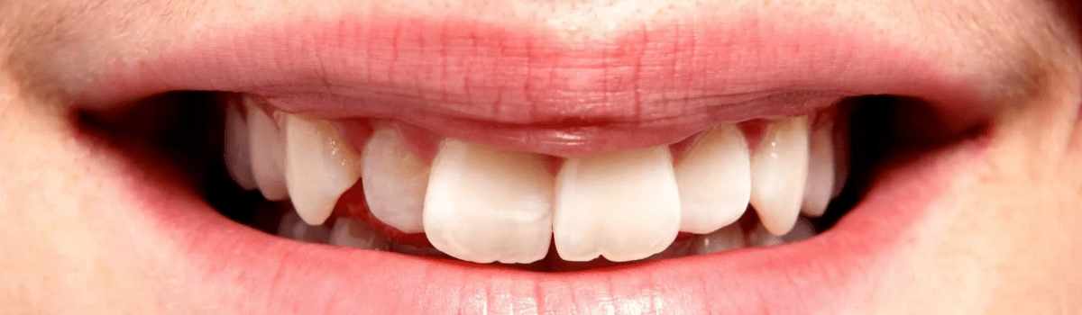 Перемещение зубов