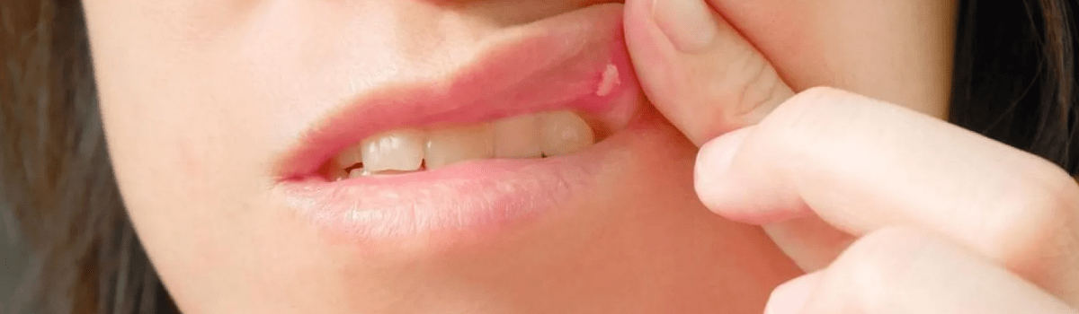 Воспалительные образования полости рта