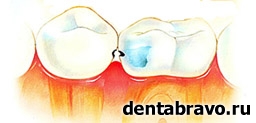 Советы стоматолога: что такое качественно сделанная пломба?