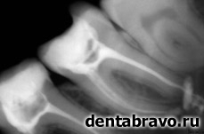 Советы стоматолога: как определить, насколько качественно запломбированы каналы?