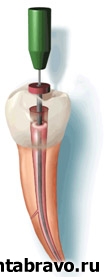 Советы стоматолога: как определить, насколько качественно запломбированы каналы?