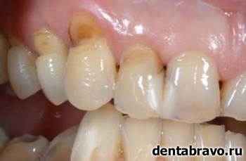 Клиновидный дефект зуба: что это, причины и лечение
