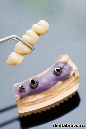 Виды зубных протезов