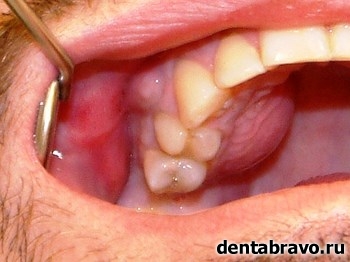 Какие существуют методы лечения кисты зуба