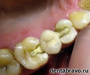 Зубные протезы на микрозамках