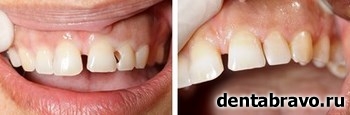 Восстановление зубов 