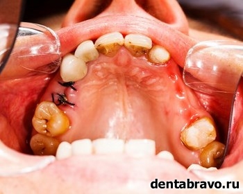 Сложное удаление корня зуба