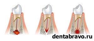 Фолликулярная киста зуба